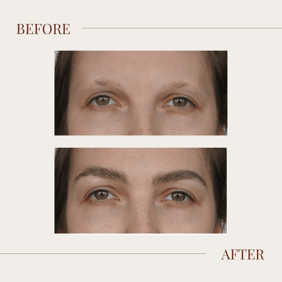 Professional before and after comparison showing sparse eyebrows transformed into full, natural-looking eyebrows after transplant procedure