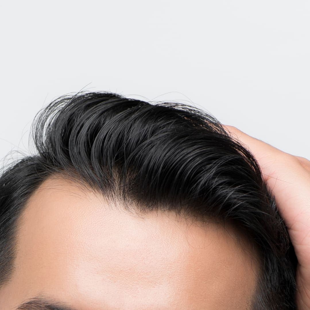 FUE procedure result showing no linear scar