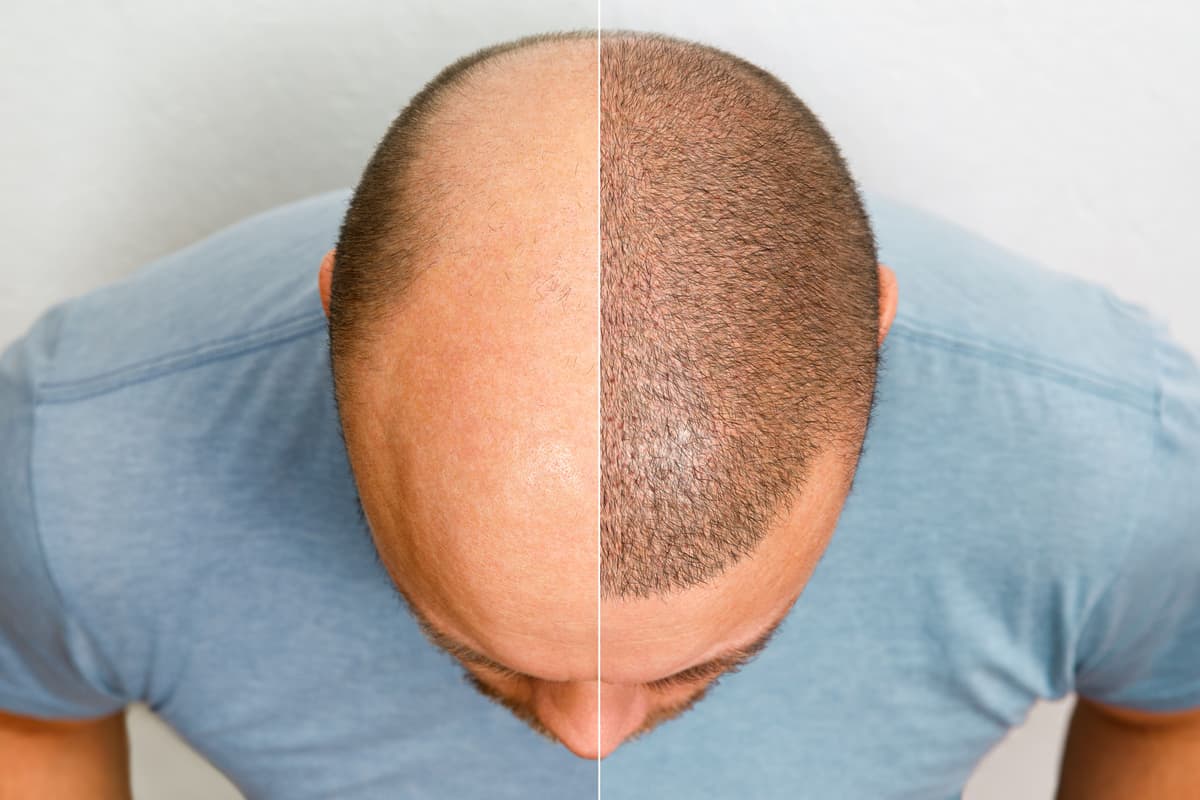 Hair transplant before and after results showing dramatic improvement from baldness to full hair coverage