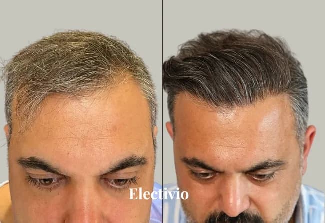 Hair transplant before and after results - Patient 1