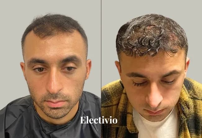 Hair transplant before and after results - Patient 14