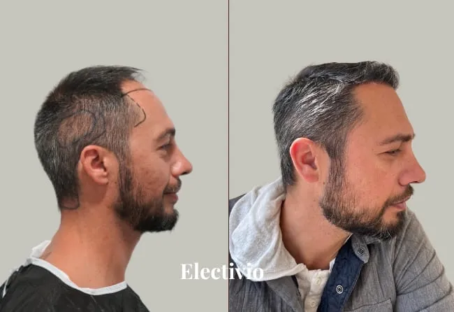 Before and after hair transplant results