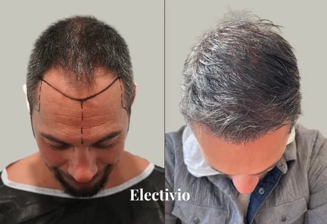 Before and after hair transplant results
