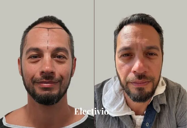 Before and after hair transplant results