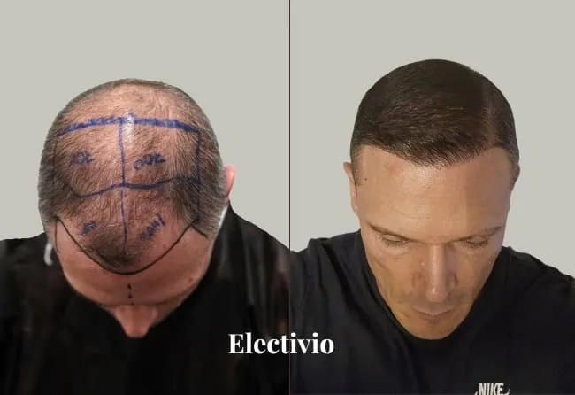 Hair transplant before and after results - Patient 16