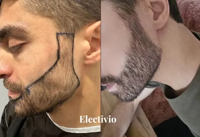 Hair transplant before and after results - Patient 27