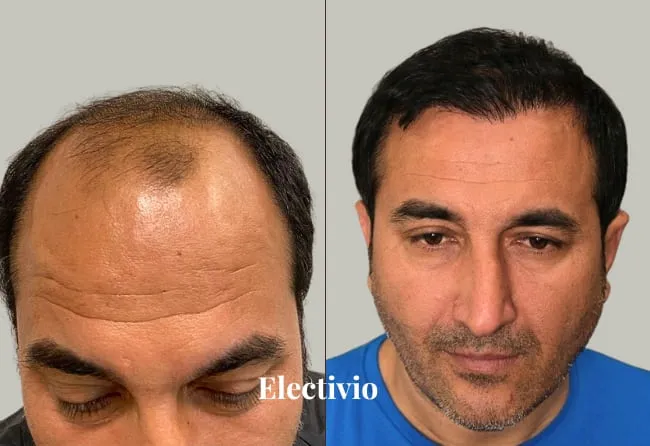 Hair transplant before and after results - Patient 4