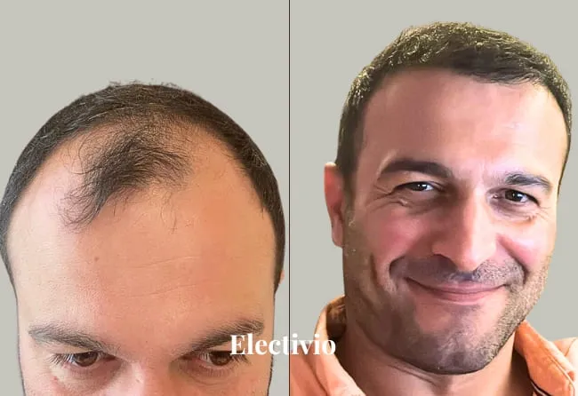 Hair transplant before and after results - Patient 9