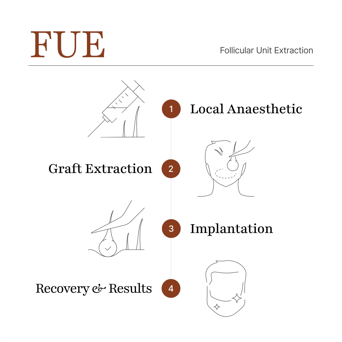 Illustration showing the DHI technique using a Choi Implanter Pen for precise beard transplant follicle placement