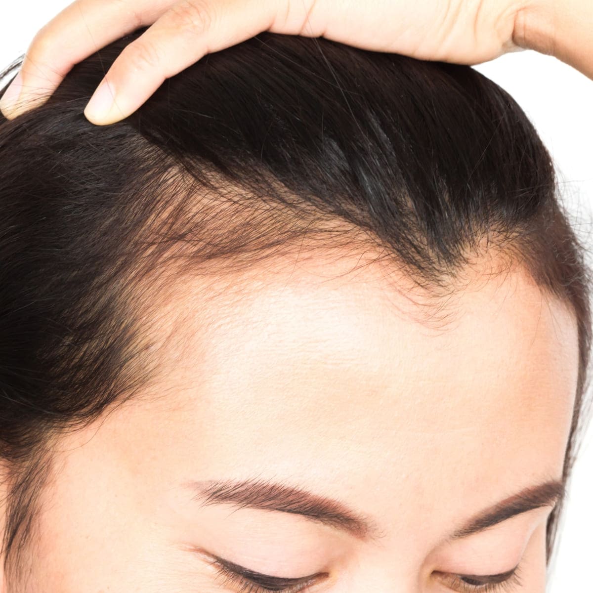 Frau nach Haartransplantation