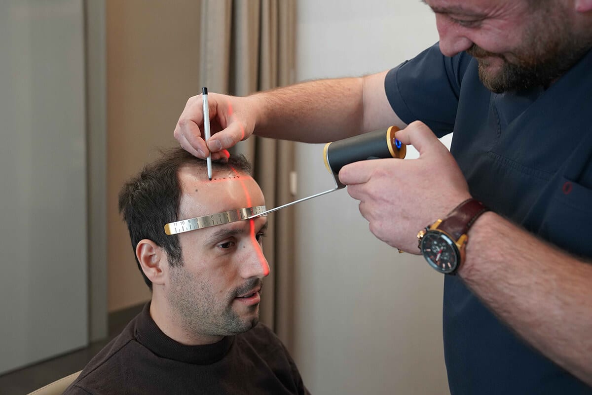 Hairline design consultation using laser alignment at Medhair Clinic