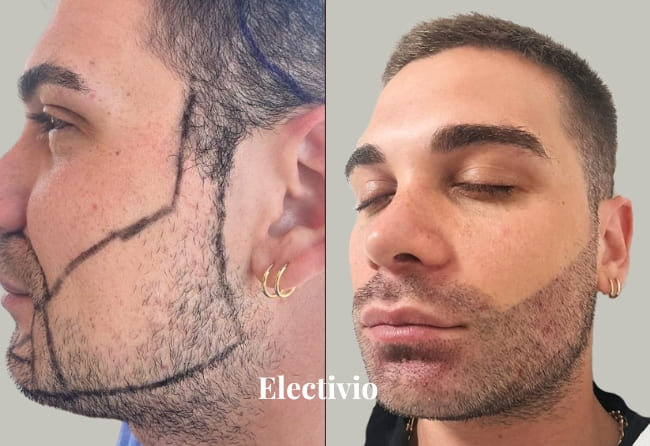 Beard transplant before and after results - Patient 10