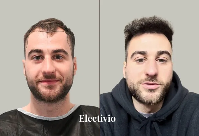 Hair transplant before and after results - Patient 23