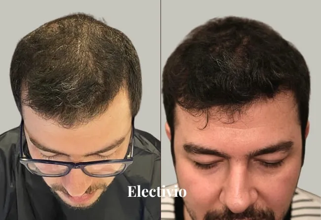 Hair transplant before and after results - Patient 2