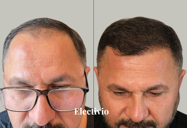 Hair transplant before and after results - Patient 3