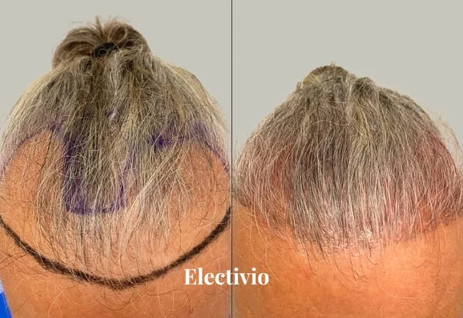 Hair transplant before and after results - Patient 5