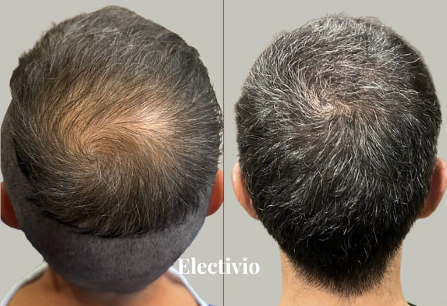 Hair transplant before and after results - Patient 8